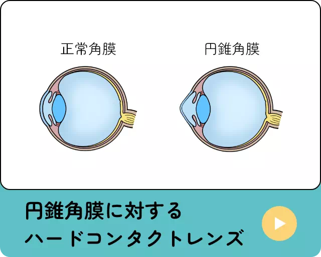 円錐角膜に対するハードコンタクトレンズ