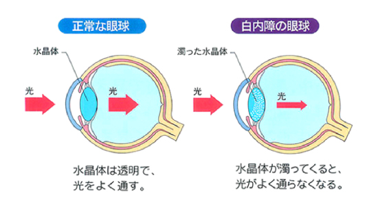 白内障について