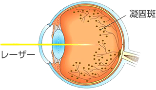 レーザー治療