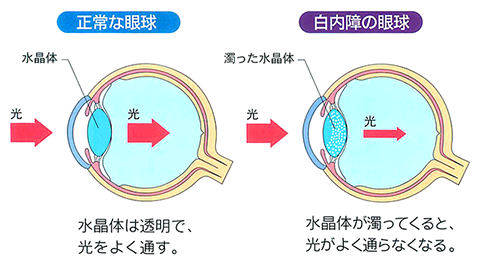 白内障は目の老化