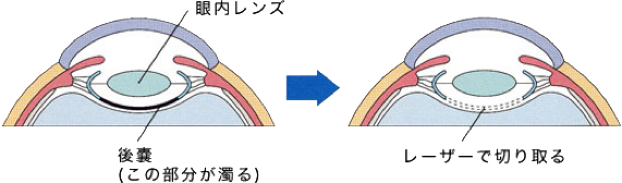 ヤグレーザー治療